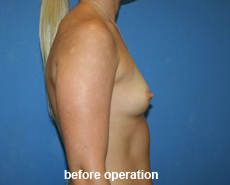 plastic-surgery-breast-augmentation